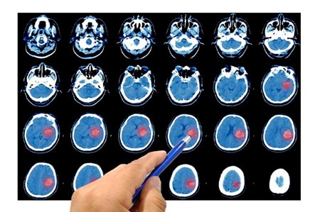 Precio de consulta de Cirugía aneurisma cerebral en Lindavista CDMX