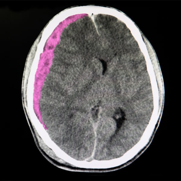 Hematomas subdural y epidural