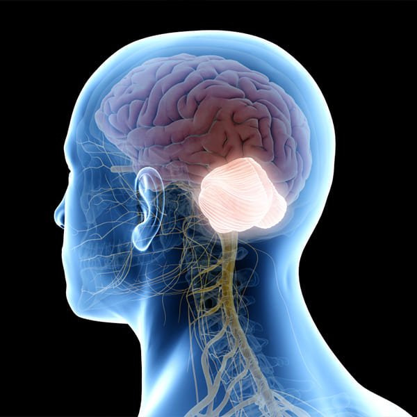 Malformación Chiari